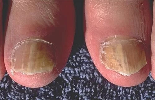 哈尔滨肤康皮肤病医院指甲剪成方形可避免得甲沟炎？