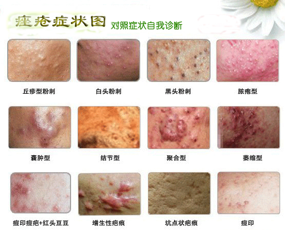 不同类型痤疮的症状图