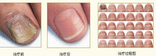 灰指甲治疗前后对比图