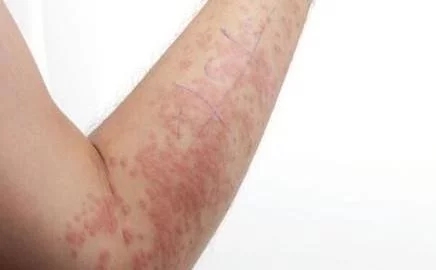 哈尔滨肤康皮肤病医院夏秋季荨麻疹怎么回事？